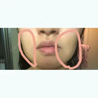 5日目の経過画像（3枚目）