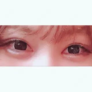 6日目の経過画像（1枚目）