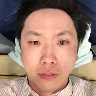 0日目の経過画像（2枚目）