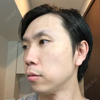 9日目の経過画像（1枚目）