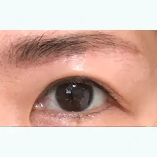 72日目の経過画像（1枚目）