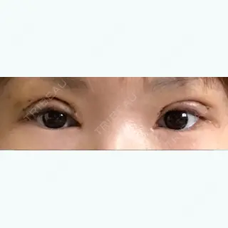 6日目の経過画像（1枚目）