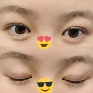 30日目の経過画像（1枚目）