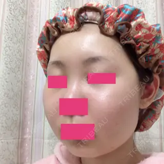 12日目の経過画像（2枚目）