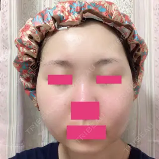 15日目の経過画像（1枚目）
