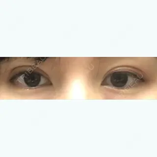 20日目の経過画像（1枚目）