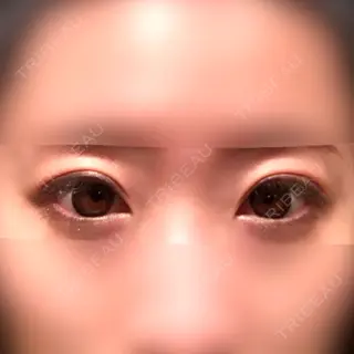 13日目の経過画像（1枚目）