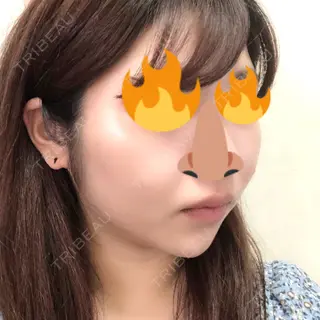 32日目の経過画像（2枚目）