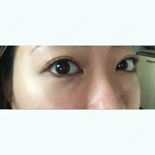 7日目の経過画像（2枚目）