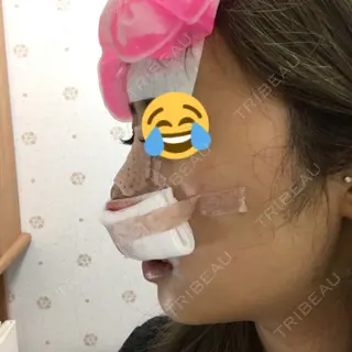 0日目の経過画像（2枚目）