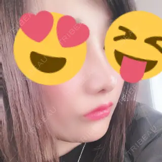 90日目の経過画像（1枚目）