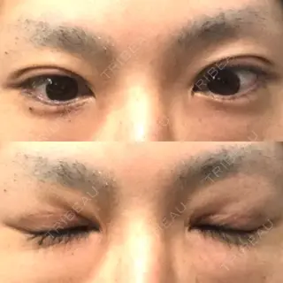 20日目の経過画像（1枚目）