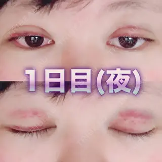 1日目の経過画像（2枚目）