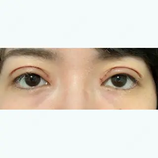 6日目の経過画像（1枚目）
