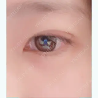 0日目の経過画像（1枚目）