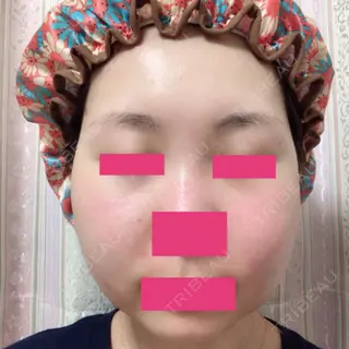 17日目の経過画像（1枚目）