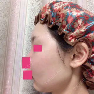 17日目の経過画像（3枚目）