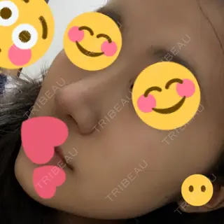 163日目の経過画像（2枚目）