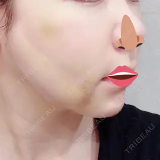 6日目の経過画像（2枚目）