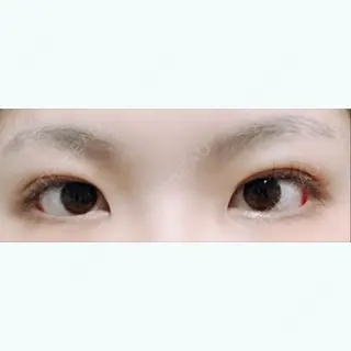18日目の経過画像（1枚目）