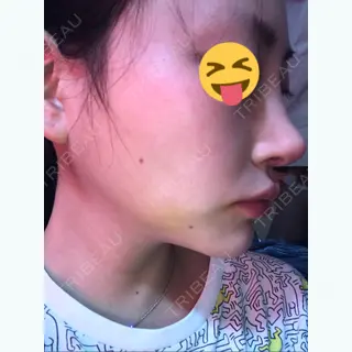 8日目の経過画像（2枚目）