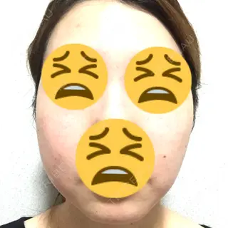 85日目の経過画像（1枚目）