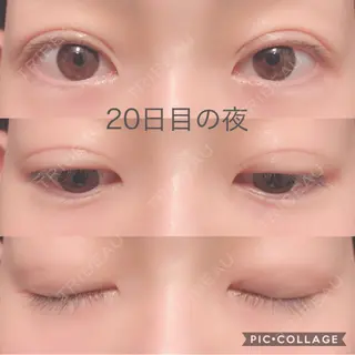 20日目の経過画像（1枚目）