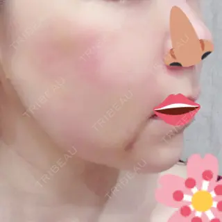7日目の経過画像（2枚目）
