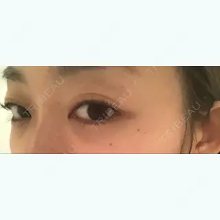8日目の経過画像（2枚目）