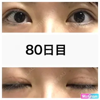 80日目の経過画像（1枚目）