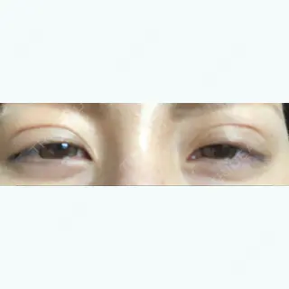 4日目の経過画像（3枚目）