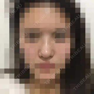 4日目の経過画像（1枚目）
