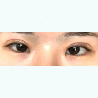 43日目の経過画像（1枚目）