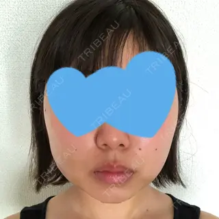 3日目の経過画像（1枚目）