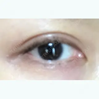 8日目の経過画像（1枚目）