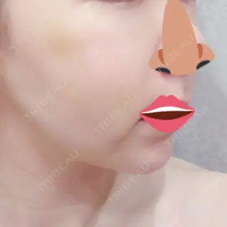 9日目の経過画像（2枚目）