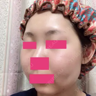 19日目の経過画像（2枚目）