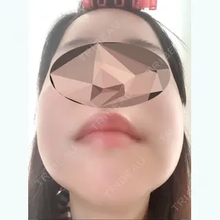 23日目の経過画像（2枚目）