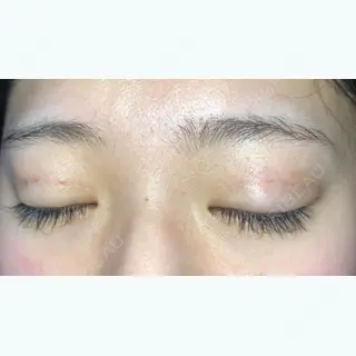 5日目の経過画像（2枚目）
