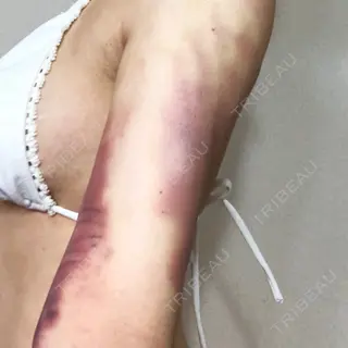 1日目の経過画像（2枚目）