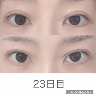 23日目の経過画像（1枚目）