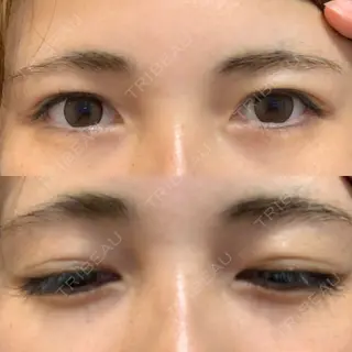 14日目の経過画像（1枚目）