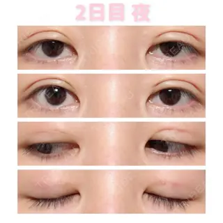 2日目の経過画像（1枚目）