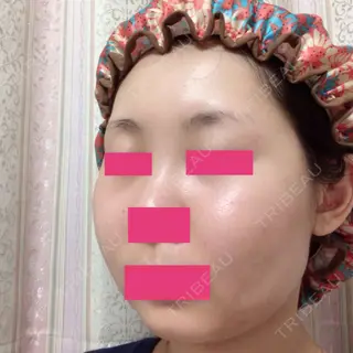 23日目の経過画像（2枚目）
