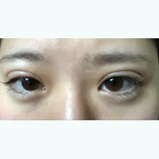 6日目の経過画像（1枚目）