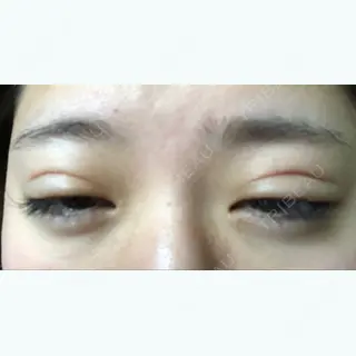 6日目の経過画像（2枚目）