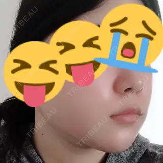3日目の経過画像（1枚目）