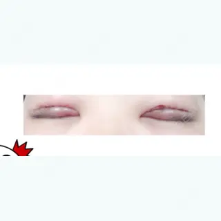 1日目の経過画像（2枚目）
