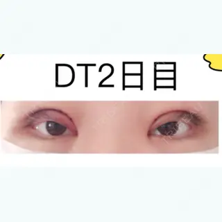 2日目の経過画像（1枚目）