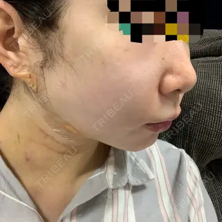 3日目の経過画像（2枚目）